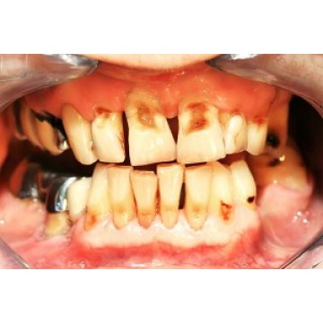 What are the effects of smokeless tobacco?